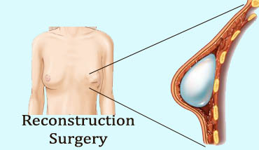 reconstruction surgery in Ranchi