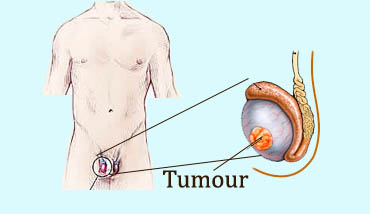 testis cancer operation in Ranchi